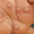 CDCmonkeypox