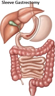 SleeveGastrectomy
