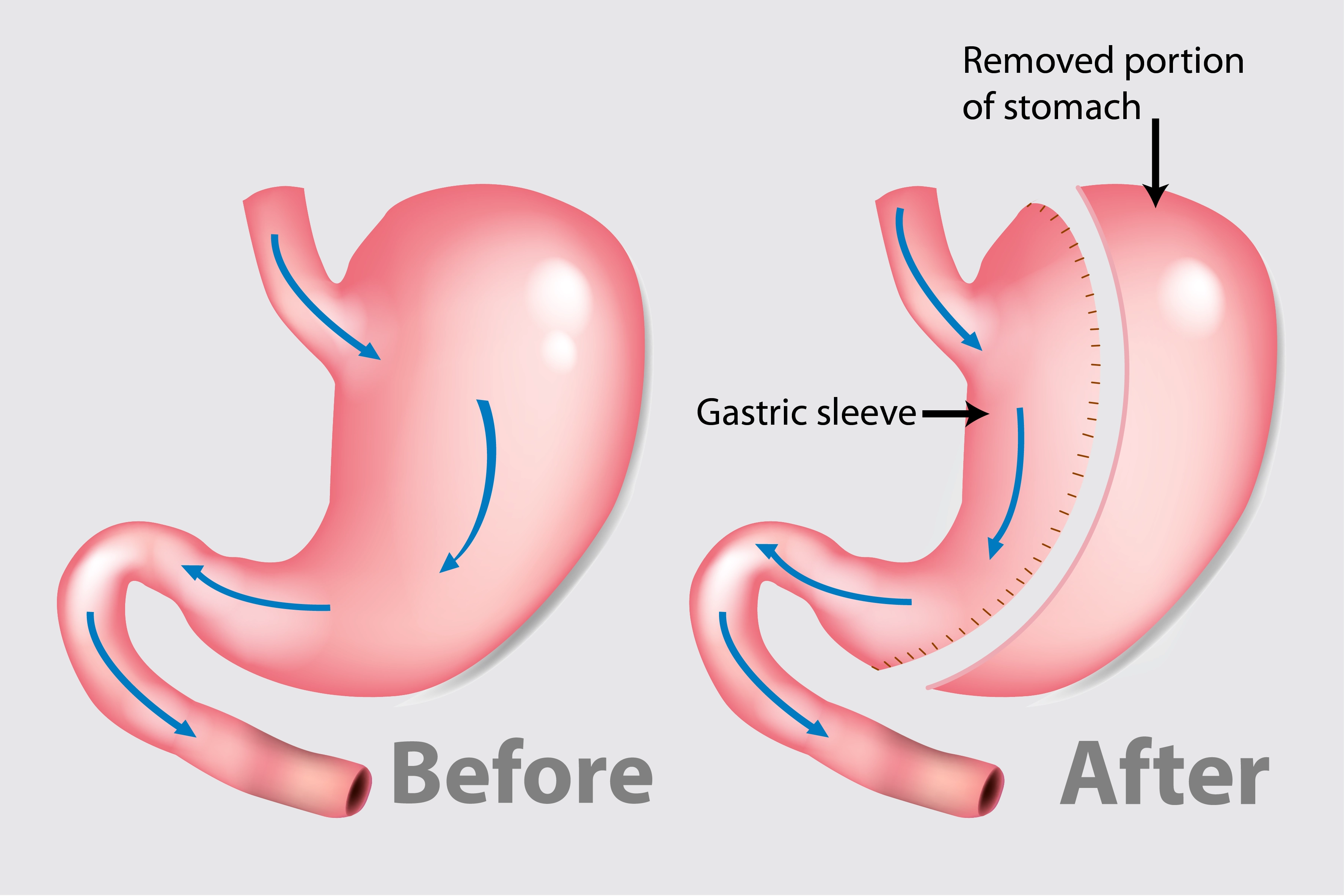 Sleevegastrectomyillustration