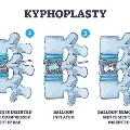 Kyphoplasty