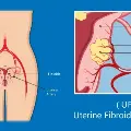 Uterineembolization