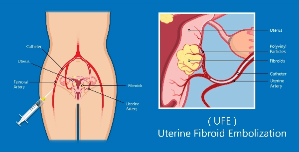 Uterine embolization