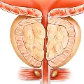 Diagramofanenlargedprostate