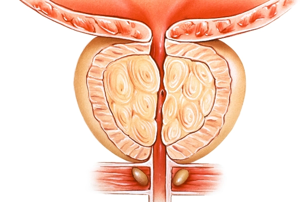 Diagram of an enlarged prostate.