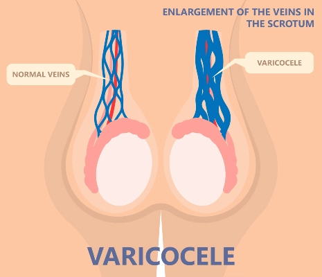 Diagram of the differences between normal veins and veins affected by varicocele.