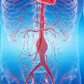 Artisticrenderingofanaorticaneurysm