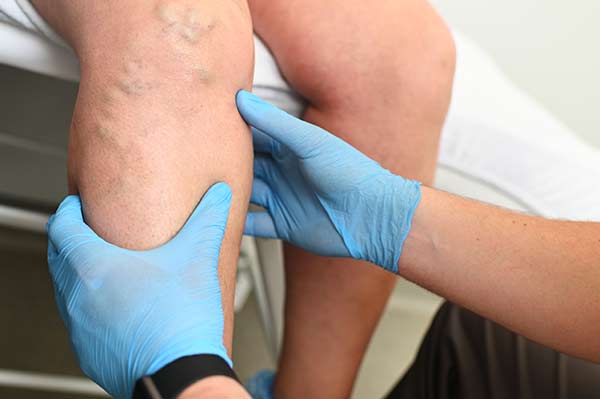 A patient with lymphedema