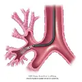 web-LungwithBTcatheterillustration