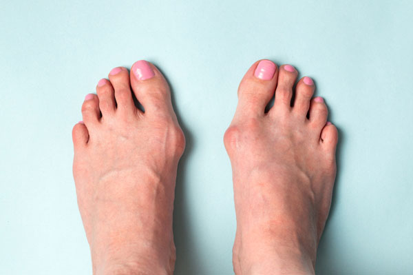 Feet with bunions