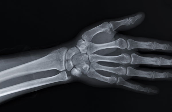 X-rayofthehandandwrist