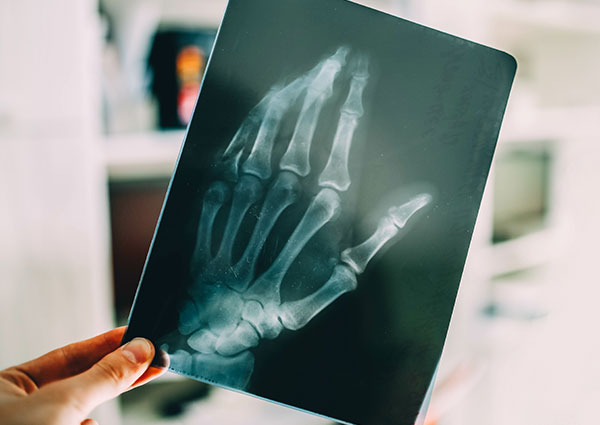 Hand x-ray with broken finger