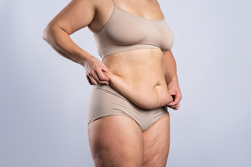 Tummy tuck surgery patient