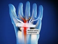 carpaltunnel_120