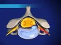 cervherniadisc_120