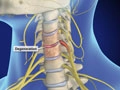 spinalstenosiscervical_120