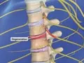 spinalstenosisthoracic_120