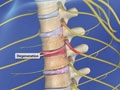 spinalstenosisthoracic_120