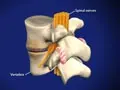 spondylosis_120