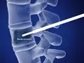 vertebroplasty_120