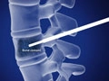 vertebroplasty_120