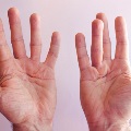 HandsofanmanwithDupuytrenscontracturedisease