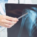 Doctorshandpointingatx-raymedicalimagingwithashouldercondition