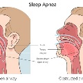 Obstructivesleepapneadiagramshowingthemouthandthroat