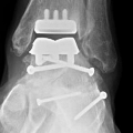 X-rayimageofananklereplacementjointwithscrews