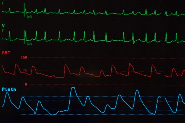 New bypass device helps save lives New bypass device helps save lives