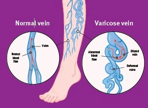 Person's legs with varicose veins behind the left knee