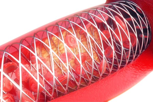 Stent prevents stroke_600x400 Stent prevents stroke_600x400