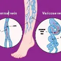 Comparisondiagramofalegwithnormalveinsandvaricoseveins